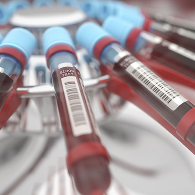 Diagnóstico de transmissão de doenças pela transfusão de sangue